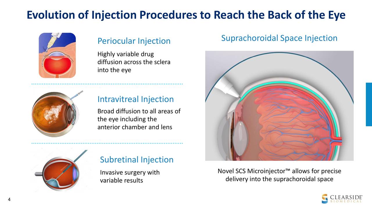Clearside Biomedical (CLSD) Presents At 38th Annual J.P.