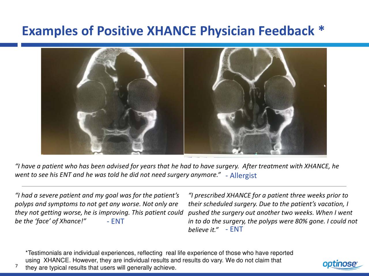 OptiNose, Inc. 2018 Q2 Results Earnings Call Slides (NASDAQOPTN